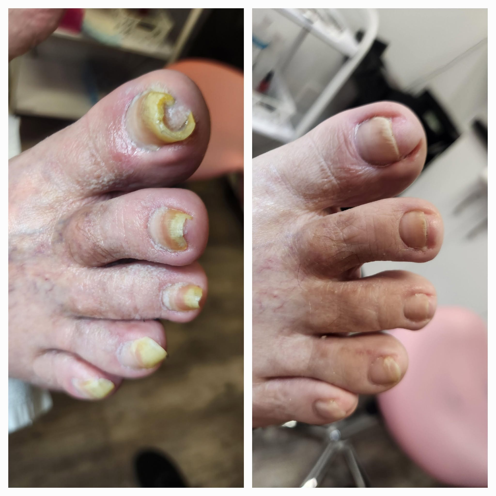 Avant et après un soin d’un ongle incarné ou en volute